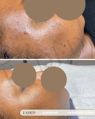 Before and after treatment at Faded Skin®