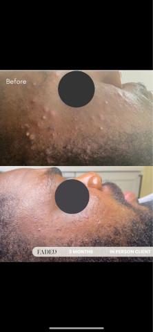 Before and after treatment at Faded Skin®