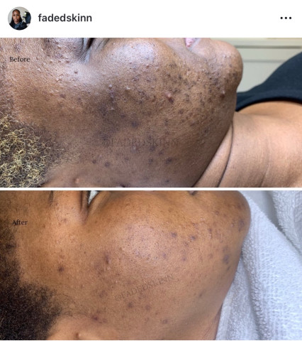 Before and after treatment at Faded Skin®