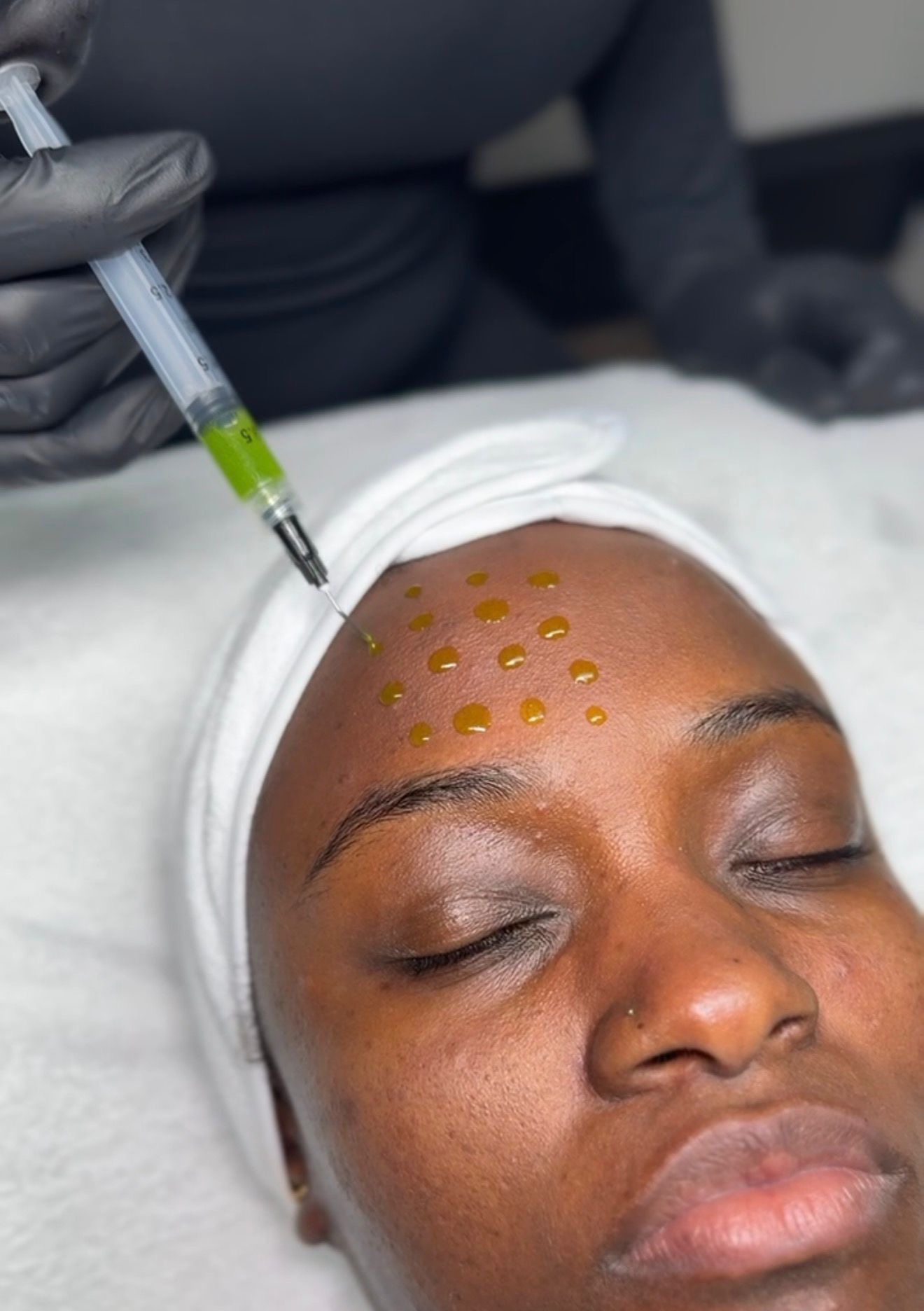 Chemical Peels treatment result at Faded Skin®