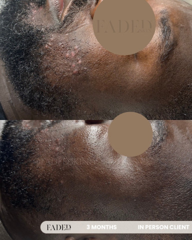Before and after treatment at Faded Skin®