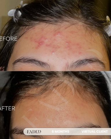 Before and after treatment at Faded Skin®
