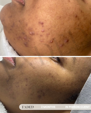 Before and after treatment at Faded Skin®