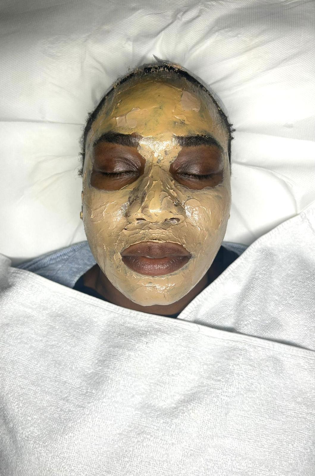 Cosmelan® treatment result at Faded Skin®