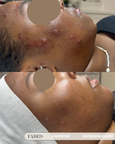Before and after treatment at Faded Skin®