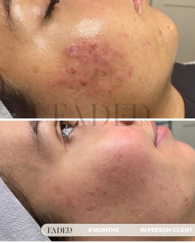 Before and after treatment at Faded Skin®