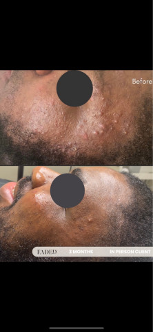 Before and after treatment at Faded Skin®