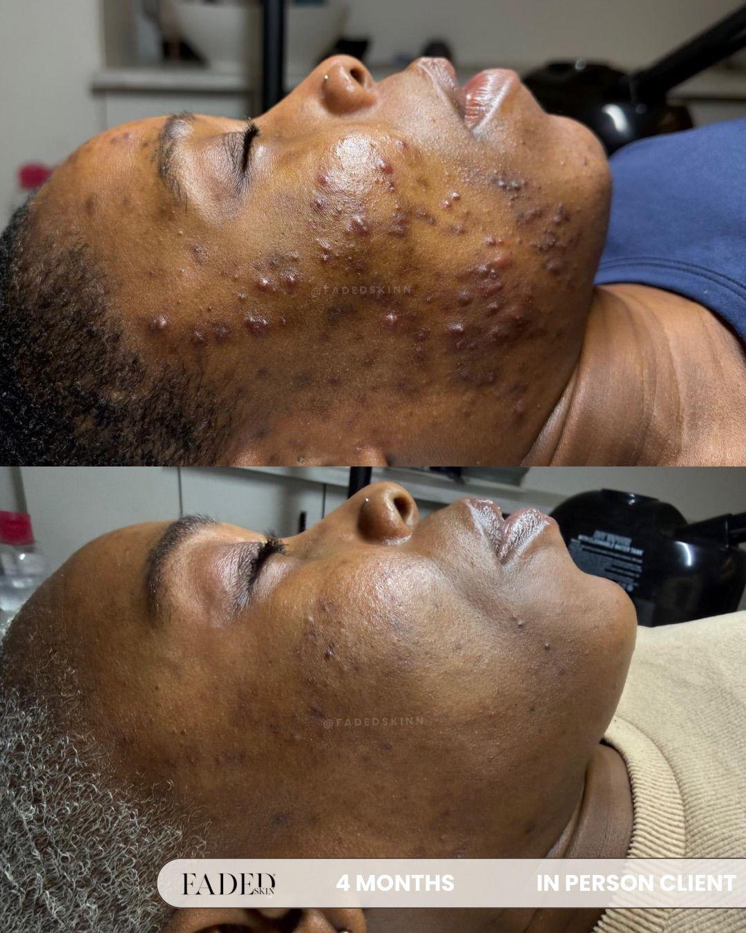 Before and after treatment at Faded Skin®